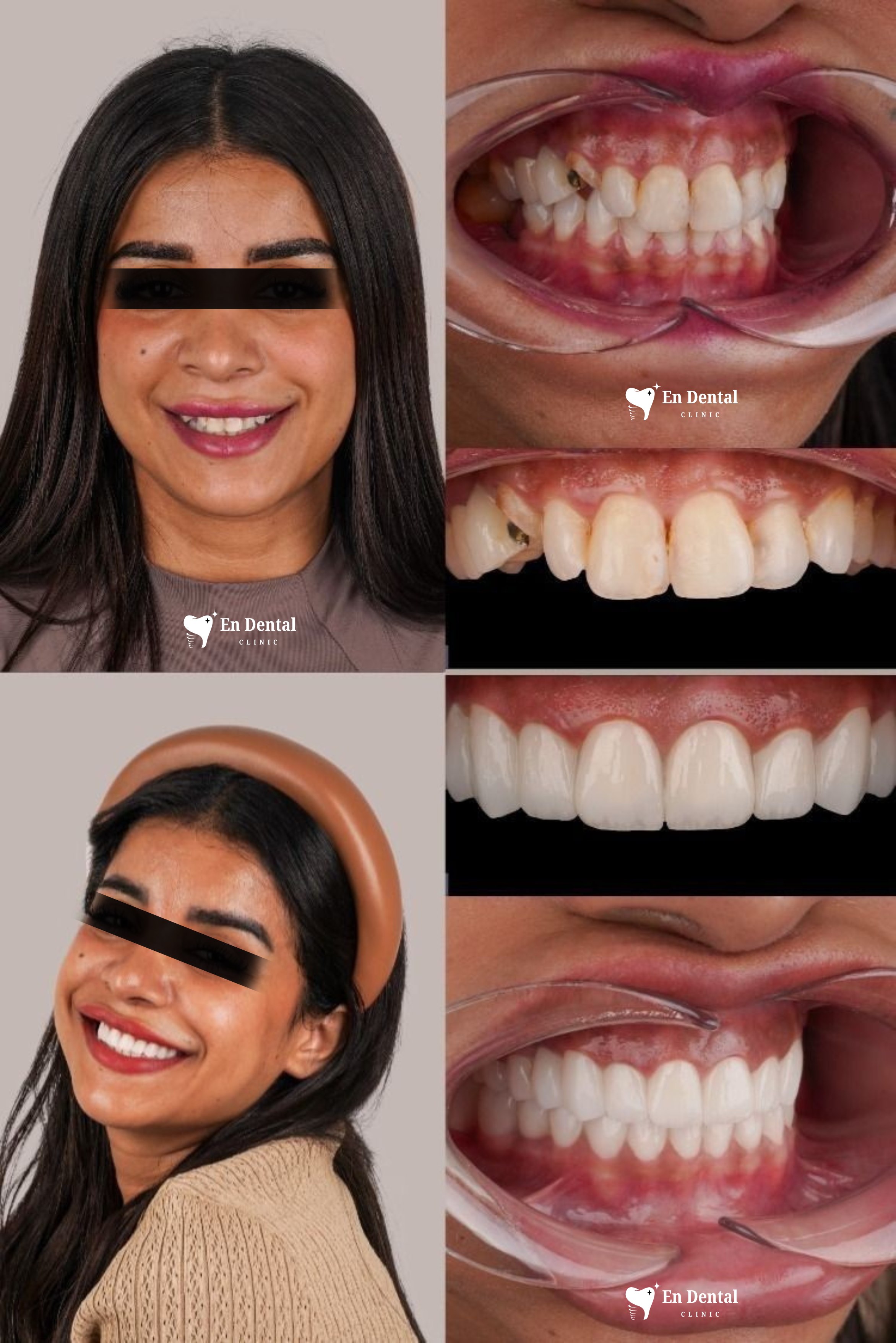 Dental transformation case 1